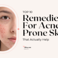 Top 10 Remedies For Acne-Prone Skin That Actually Help 4 A skincare graphic highlighting the top 10 Remedies For Acne-Prone Skin, featuring a close-up portrait of a woman's face showing blemish-prone skin and redness framed in an oval border.