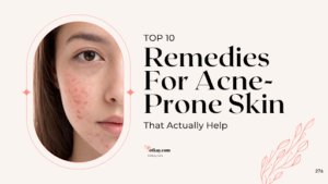 Homepage 26 A skincare graphic highlighting the top 10 Remedies For Acne-Prone Skin, featuring a close-up portrait of a woman's face showing blemish-prone skin and redness framed in an oval border.