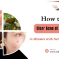 How to Clear Acne at Home in Minutes with Natural Remedy  - totkay.com