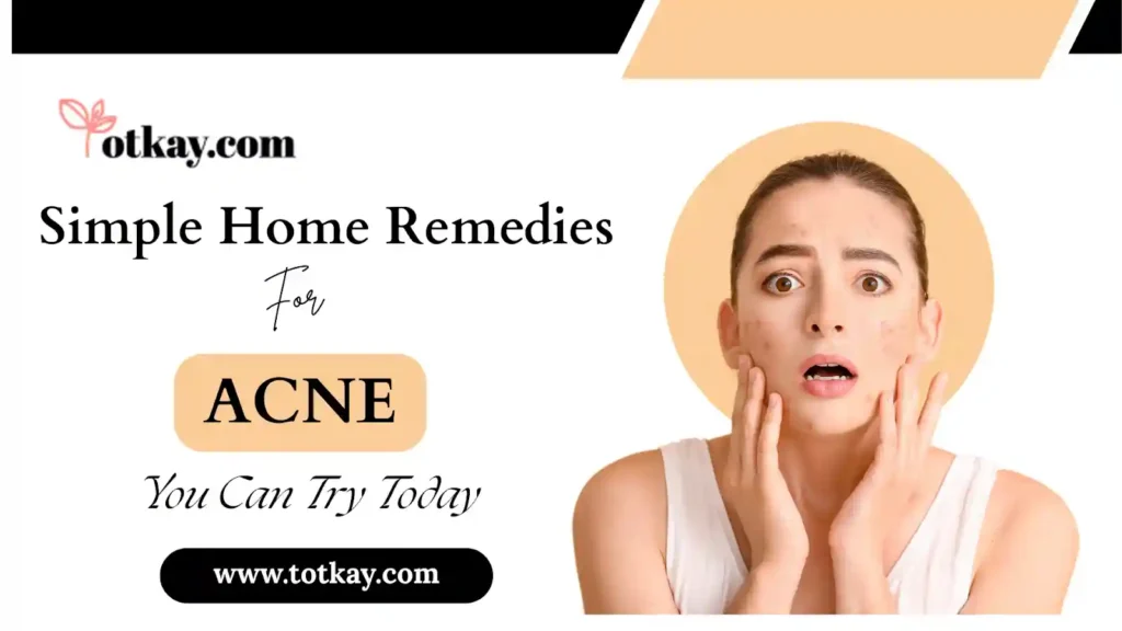 Simple Home Remedies for Acne - totkay.com