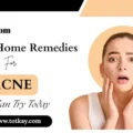 Simple Home Remedies for Acne - totkay.com