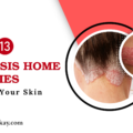 13 Psoriasis Home Remedies Soothe Your Skin
