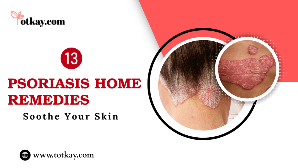 13 Psoriasis Home Remedies Soothe Your Skin - totkay.com