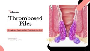 Thrombosed Piles