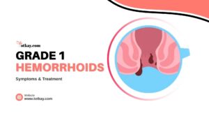 Grade 1 Hemorrhoids