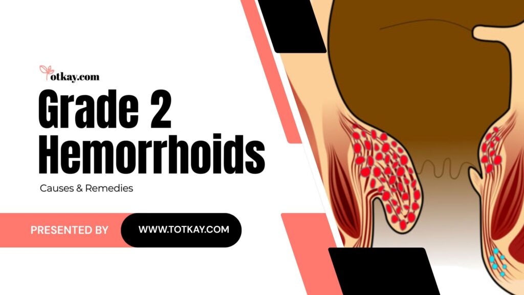Grade 2 Hemorrhoids