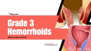 Grade 3 Hemorrhoids