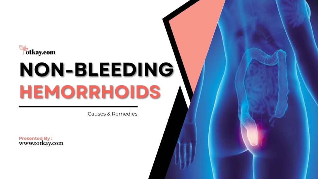 Non-Bleeding Hemorrhoids