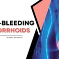 Non-Bleeding Hemorrhoids