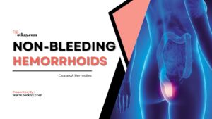 Non-Bleeding Hemorrhoids